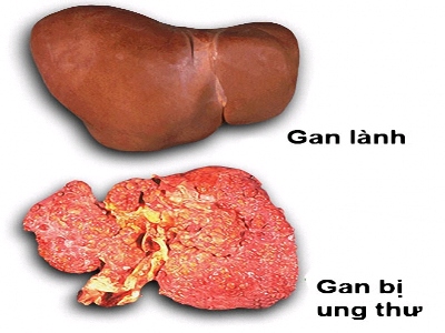 12 dấu hiệu nhận biết ung thư gan
