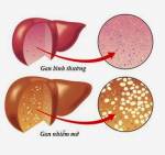 Cây thuốc dân gian trị Gan nhiễm mỡ