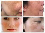 Thảo dược trị nám da